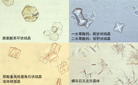 鈥激光腔內(nèi)碎石