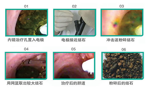 膽結(jié)石治療，體內(nèi)沖擊波碎石機(jī)操作流程