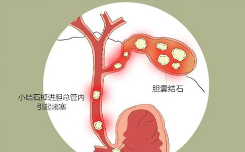 肝膽結(jié)石碎石機,體內(nèi)沖擊波膽道液電碎石儀,肝膽微創(chuàng)碎石術(shù)