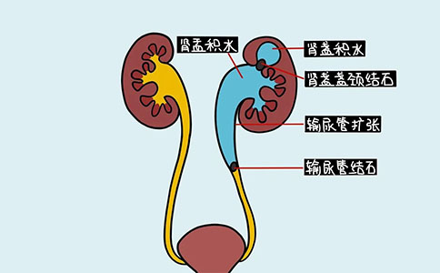 腎結(jié)石
