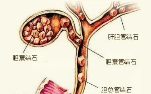 膽結(jié)石