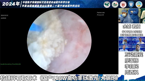 軟鏡碎石取石術(shù)（國產(chǎn)120W高功率鈥激光/大鋼炮）