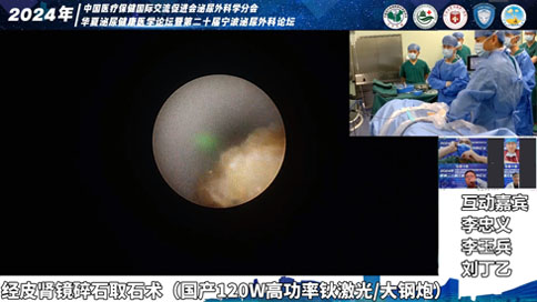 經(jīng)皮腎鏡碎石取石術(shù)（國產(chǎn)120W高功率鈥激光/大鋼炮）