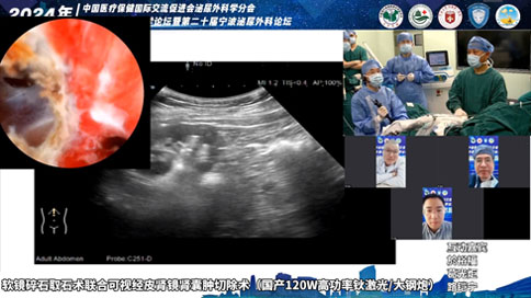 軟鏡碎石取石術(shù)聯(lián)合可視經(jīng)皮腎鏡腎囊腫切除術(shù)（國產(chǎn)120W高功率鈥激光/大鋼炮）
