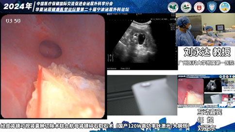 經(jīng)皮腎鏡可視腎囊腫切除術(shù)聯(lián)合航母腎鏡碎石取石術(shù)（國產(chǎn)120W高功率鈥激光/大鋼炮）