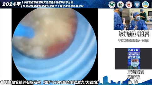 輸尿管軟鏡碎石取石術(shù)（國產(chǎn)120W高功率鈥激光/大鋼炮）