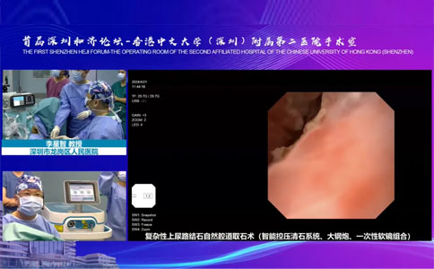 軟鏡碎石取石術(shù)