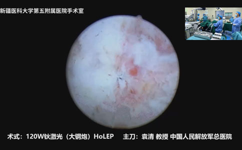120W鈥激光(大鋼炮)HoLEP手術(shù)