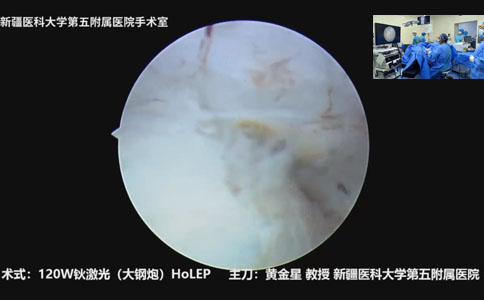 120W鈥激光(大鋼炮)HoLEP手術(shù)