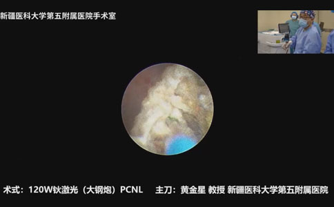120W鈥激光(大鋼炮)PCNL