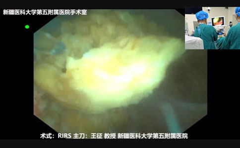 便攜式鈥激光(小鋼炮) RIRS