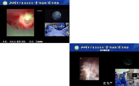 鈥激光軟鏡碎石術