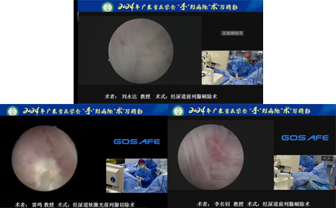 經(jīng)尿道前列腺鈥激光剜除術