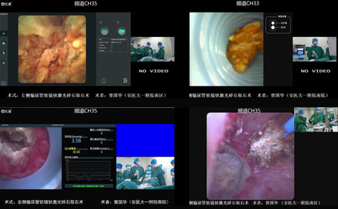 輸尿管軟鏡鈥激光碎石取石術(shù)