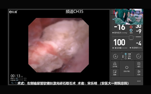 左側(cè)輸尿管軟鏡鈥激光碎石取石術(shù)