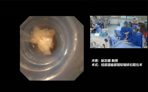 軟鏡碎石取石術(shù)