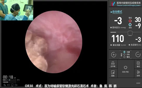 輸尿管軟鏡碎石清石術(shù)