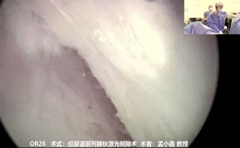 經(jīng)尿道前列腺鈥激光剜除術(shù)