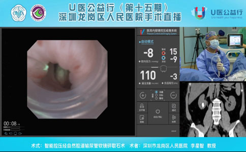 輸尿管軟鏡碎石取石術(shù)