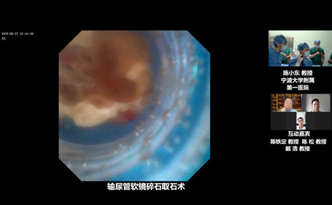 大鋼炮碎石取石術(shù)