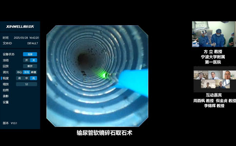 軟鏡碎石取石術(shù)