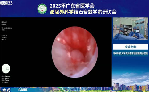 高功率鈥激光右RIRS