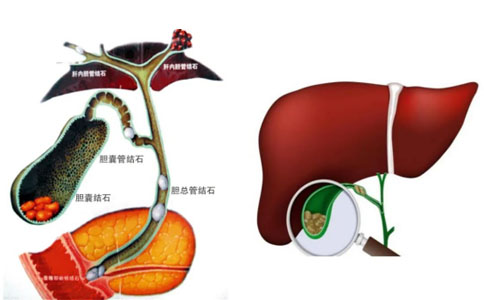 肝膽結石激光