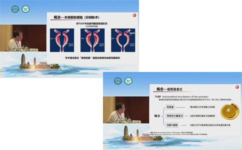 經(jīng)尿道前列腺剜除術(shù)
